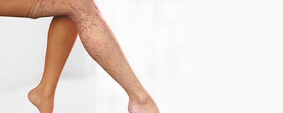Compression Stocking (Varicose Veins)